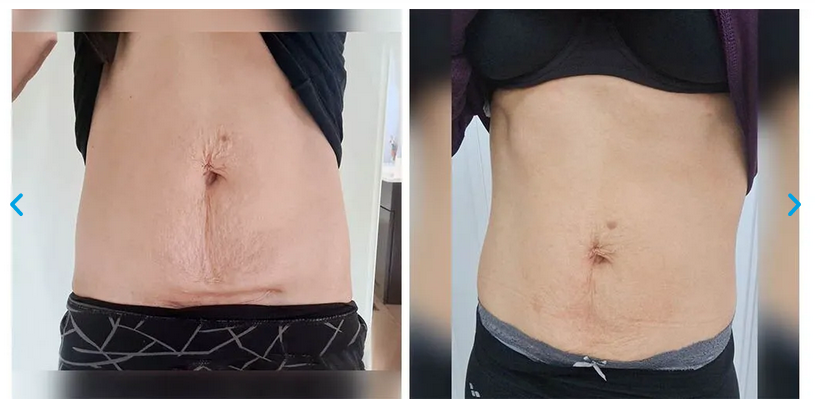 Bauch 1