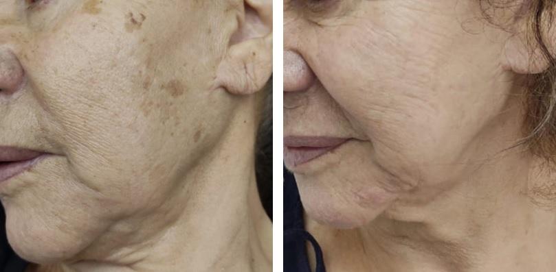 Hautbildverbesserung nach 2 Behandlungen