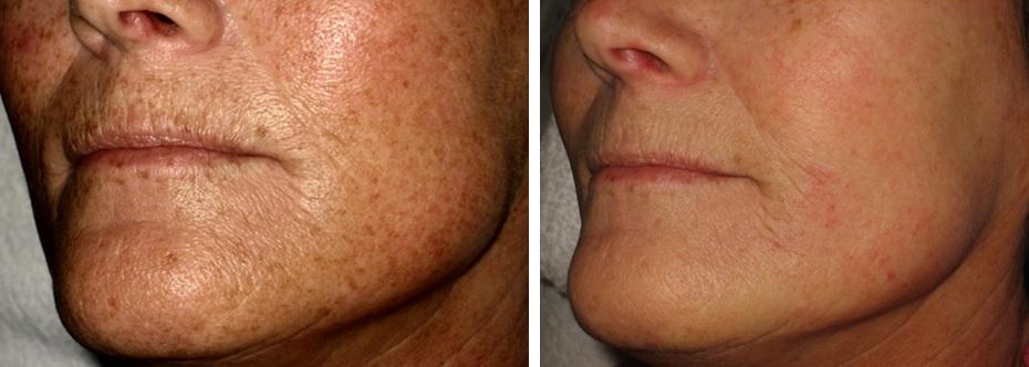 Anti-Age-Behandlung nach 3 Behandlungen