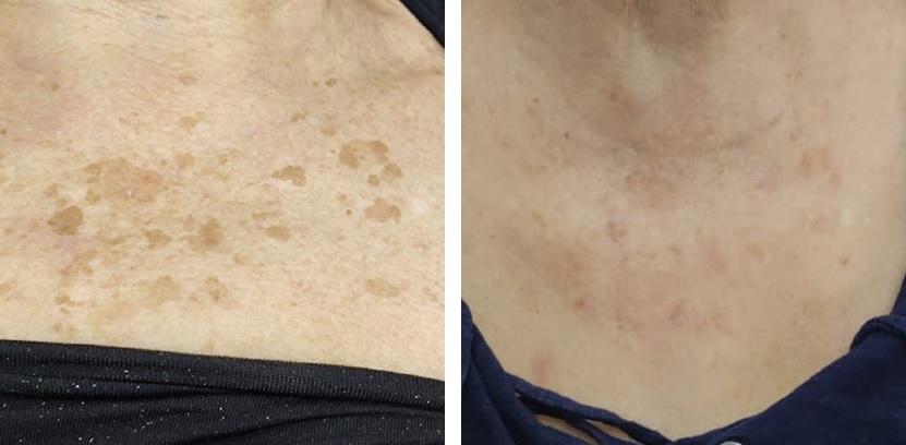 Hautbildverbesserung Dekollté nach 2 Behandlungen