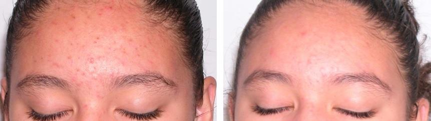 Aknebehandlung nach 2 Behandlungen