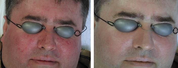 Hautbildverbesserung nach 3 Behandlungen