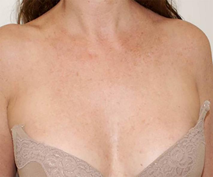 Hautverbesserung nach 2 Behandlungen