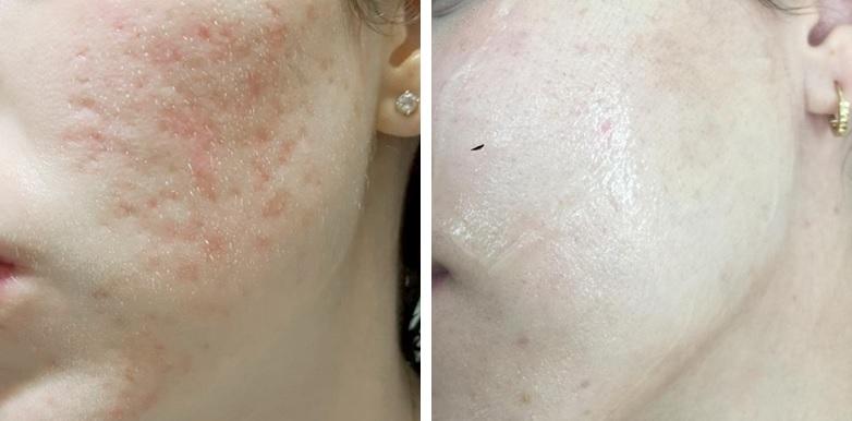 Aknebehandlung nach 4 Behandlungen
