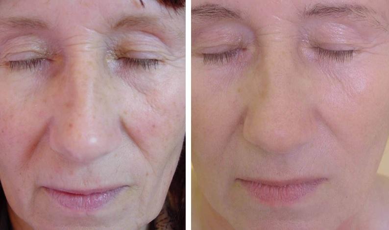 Hautauffrischung nach 3 Behandlungen