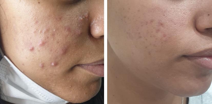Aknebehandlung nach 3 Behandlungen