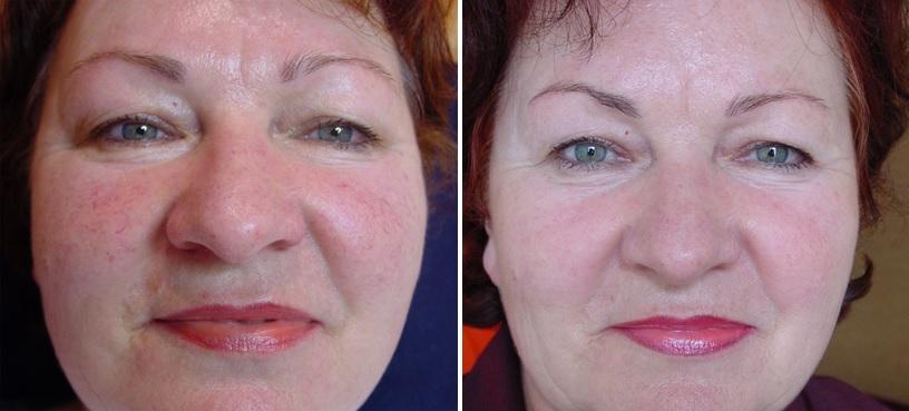 Hautverbesserung nach 3 Behandlungen