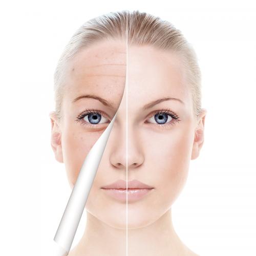 Micro-Needling