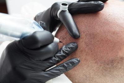 Nach-Kophhautbehandlung