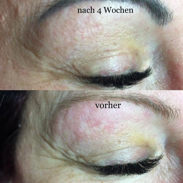 Behandlung Schlupflid und Krähenfüße, Ergebnis nach nur  einer Behandlung