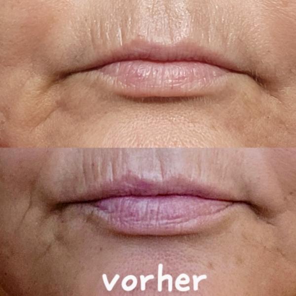 Behandlung Lippenfalten, Ergebnis nach nur einer Behandlung