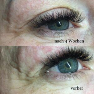 Plasma Pen Lifting Behandlung Leipzig